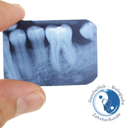 Die Wurzelkanalbehandlung dient der Erhaltung stark beschädigter bzw. erkrankter Zähne. Sie wird dann notwendig, wenn das im Zahninnern liegende, von außen nicht sichtbare Zahnmark (der so genannte „Zahnnerv“) durch eine tiefe Karies, eine Entzündung oder eine Verletzung angegriffen ist.Bei der Wurzelkanalbehandlung wird das erkrankte Zahnmark entfernt. Der Wurzelkanal wird erweitert, gereinigt, desinfiziert und bakteriendicht verschlossen.Die Behandlung wird in tiefer örtlicher Betäubung durchgeführt und ist völlig schmerzfrei.Um eine erneute Entzündung auszuschließen, kommt es bei der Wurzelkanalbehandlung vor allem darauf an, das beschädigte Gewebe gründlich zu entfernen und bakteriendicht zu verschließen.